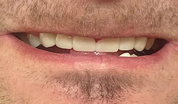 After image